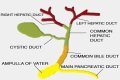 What is cystic duct obstruction